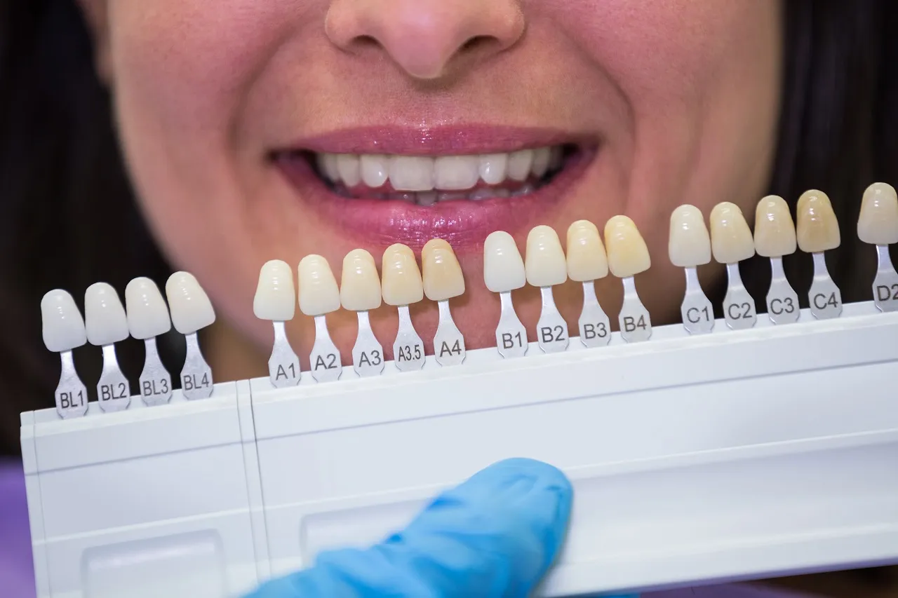 Dental Veneers Overview